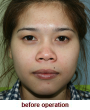 plastic_surgery_augmentation_rhinoplasty